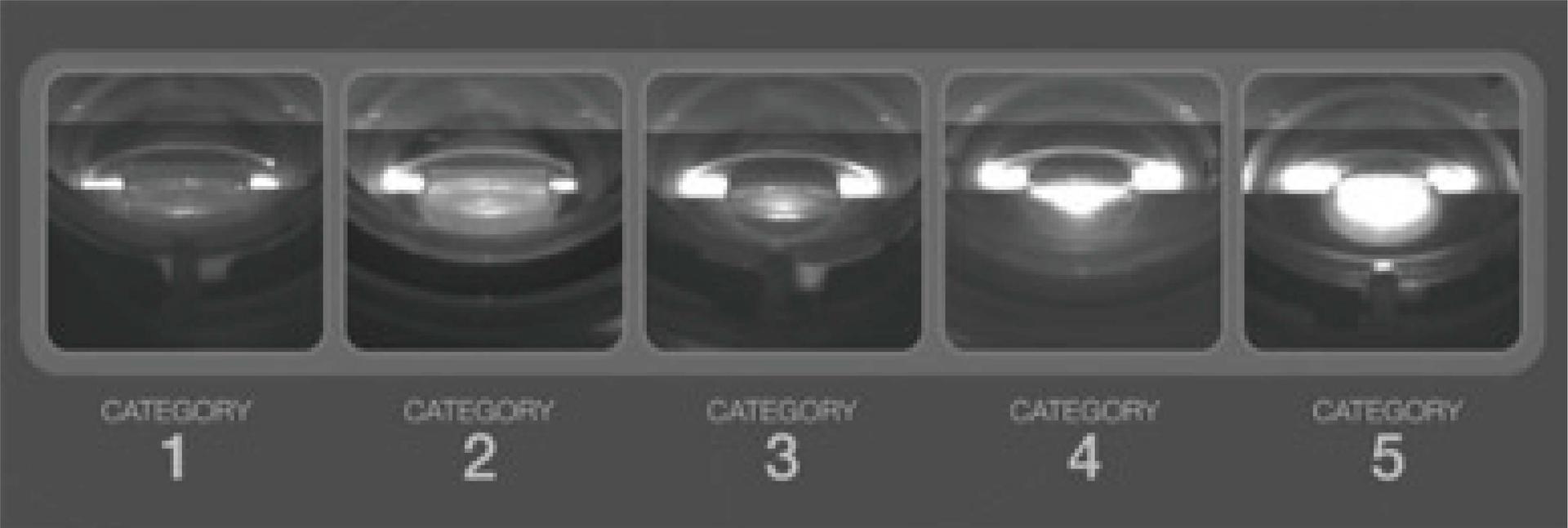 自動分類白內障