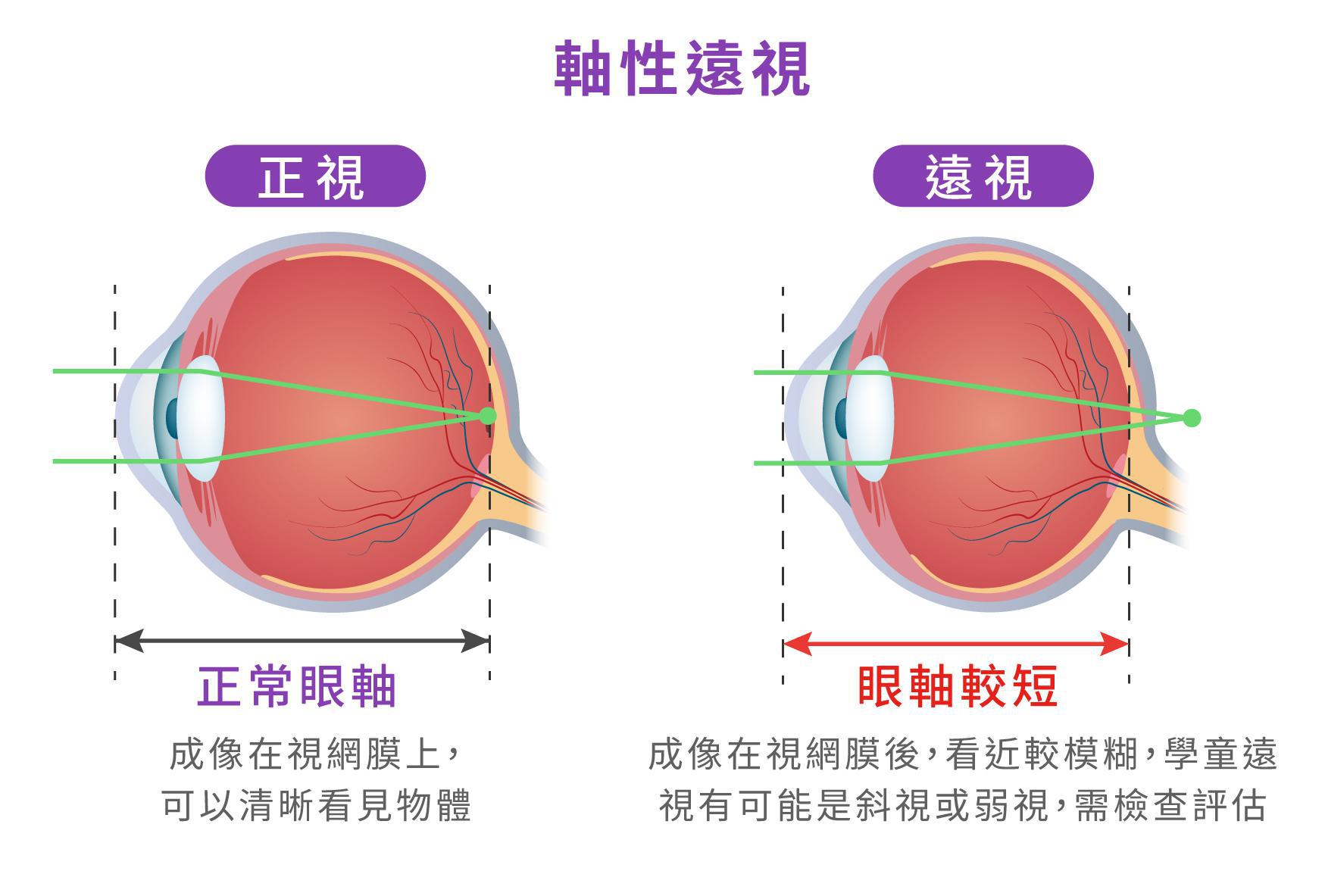 軸性遠視的介紹