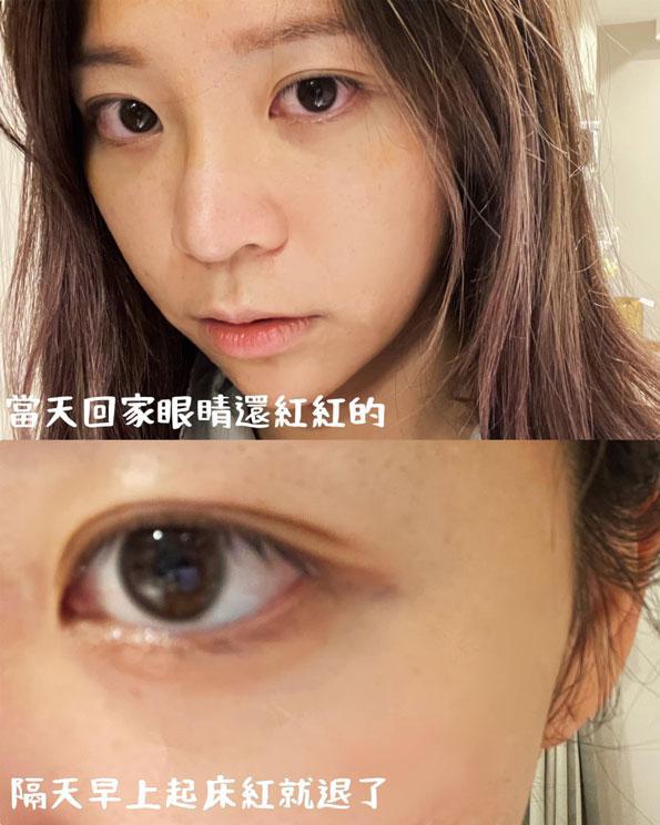 雪莉零,諾貝爾眼科,smile全飛秒,近視雷射