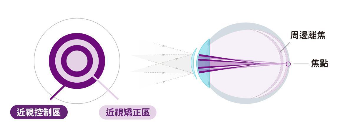 近視控制日拋原理