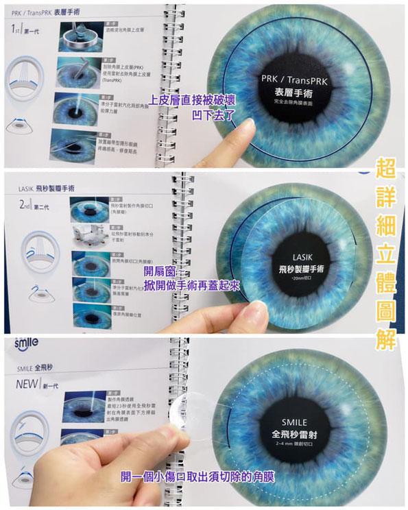 俞瑄,諾貝爾眼科,沈仁翔醫師,Smile全飛秒,近視雷射