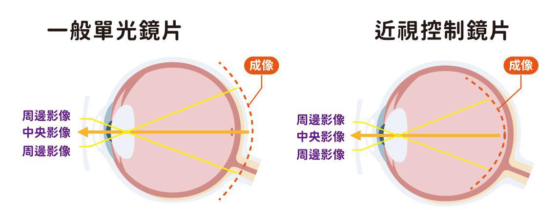 近視控制鏡片原理