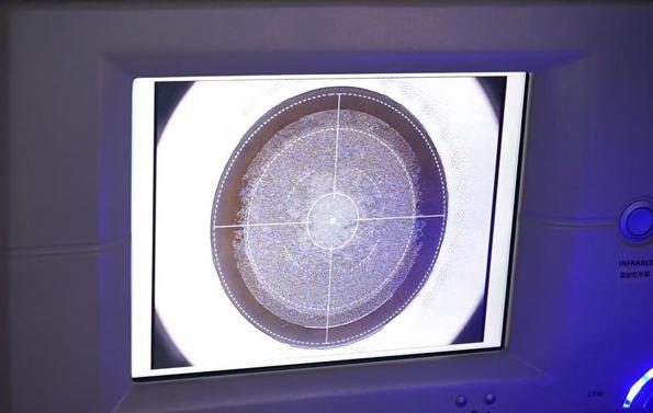 諾貝爾眼科,蔡力允,smile全飛秒,近視手術