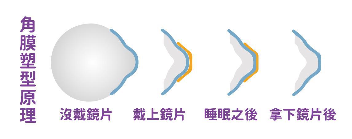 角膜塑型片原理
