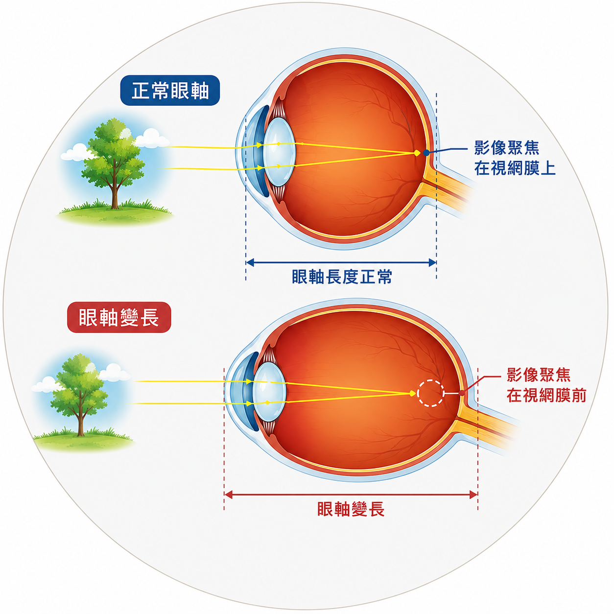 眼軸變長與近視度數的關係