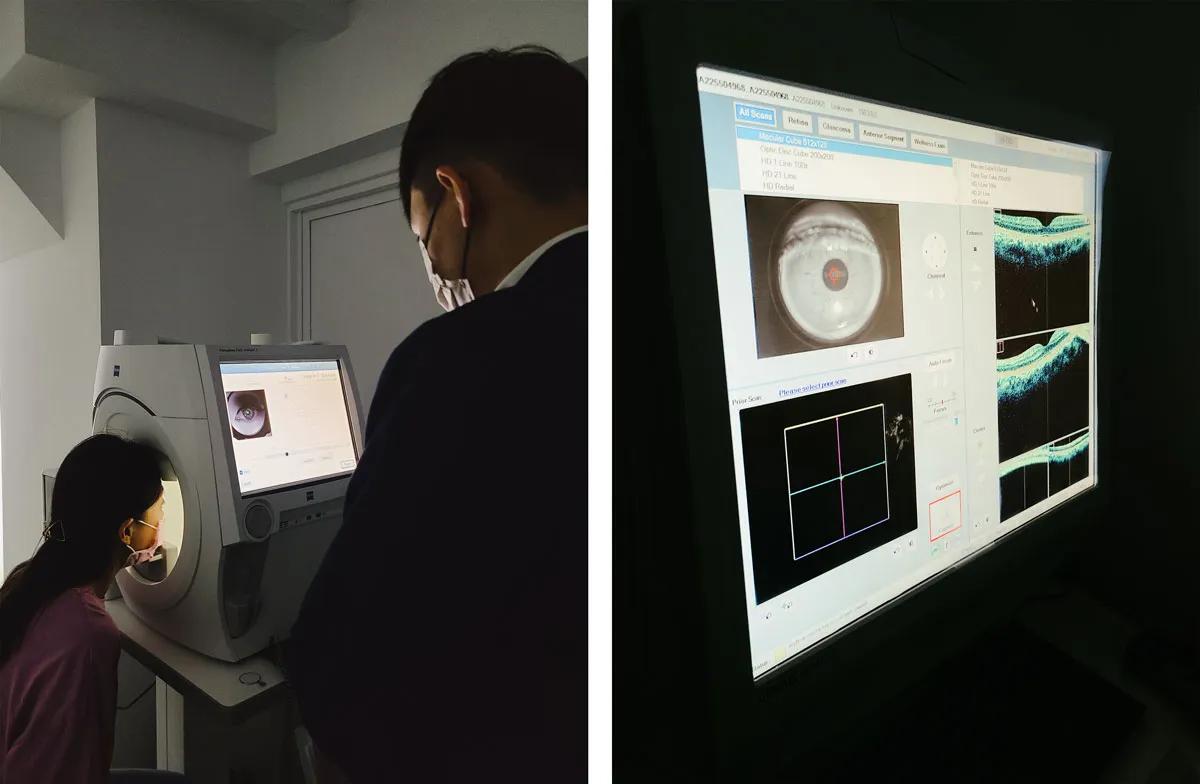 焦糖甜一點,近視雷射,smile全飛秒,諾貝爾眼科