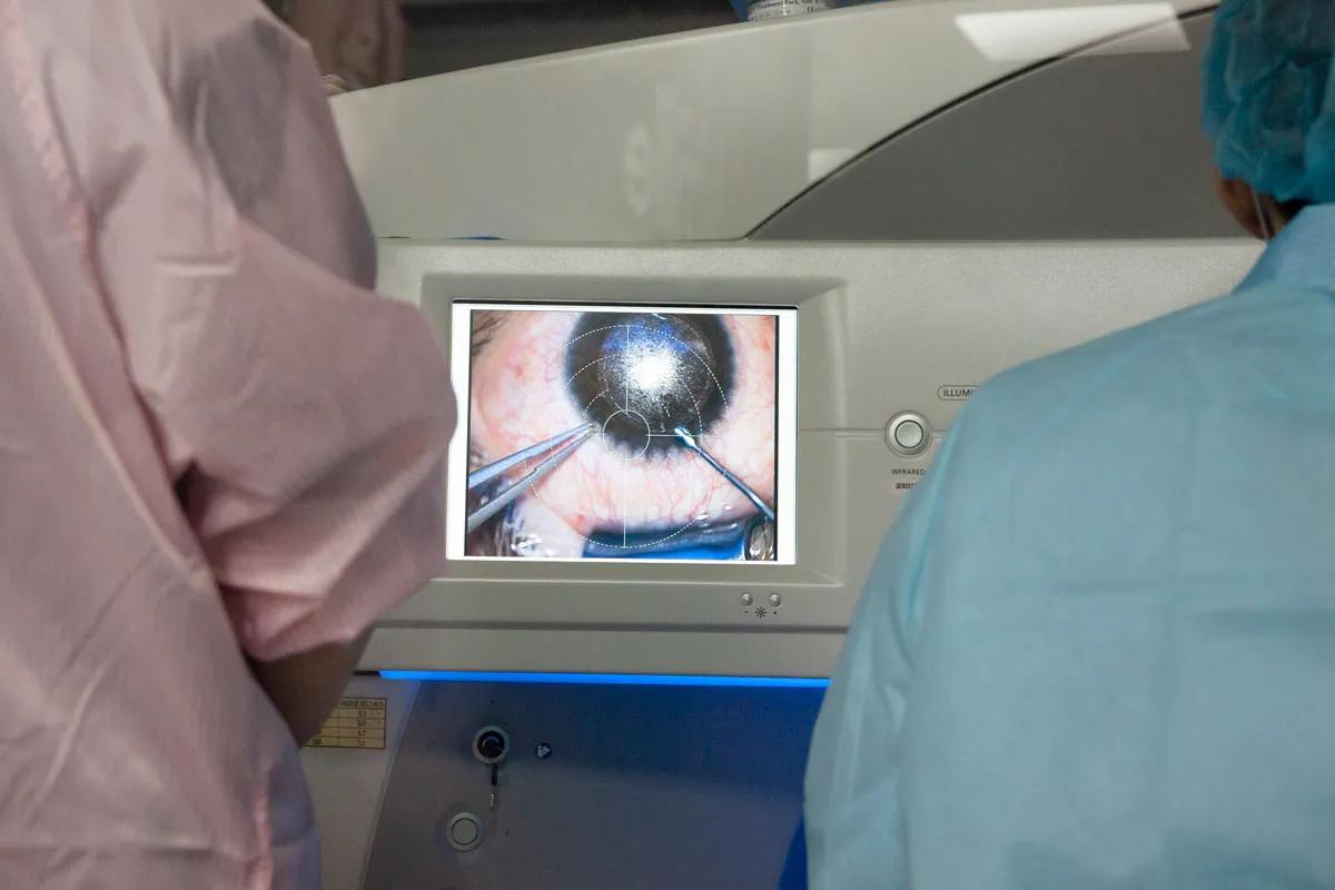 焦糖甜一點,近視雷射,smile全飛秒,諾貝爾眼科